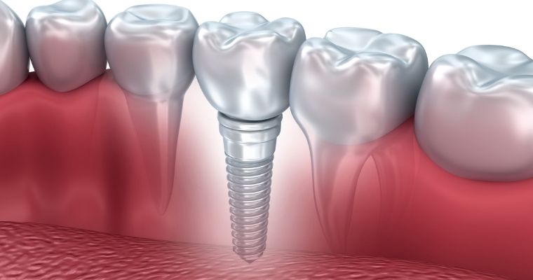 Cheapest Place to Get All-on-4 Dental Implants